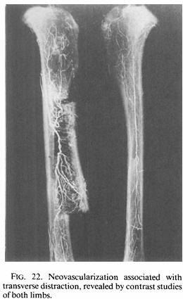 Contrast radiographs of two limbs showing neovascularization associated with transverse distraction